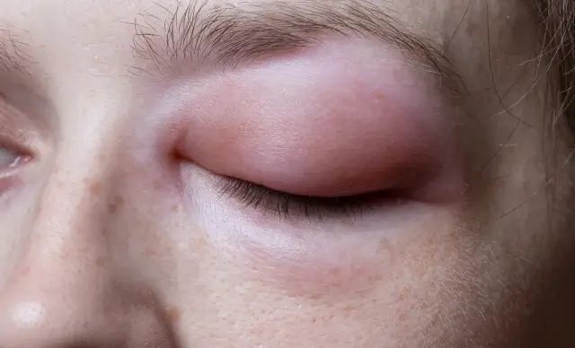 Woman with swollen eye issue