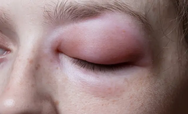 Angioedema