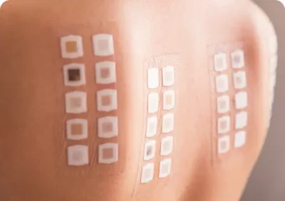 Allergy Patch Testing