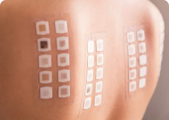 Allergy patch Testing on the Back