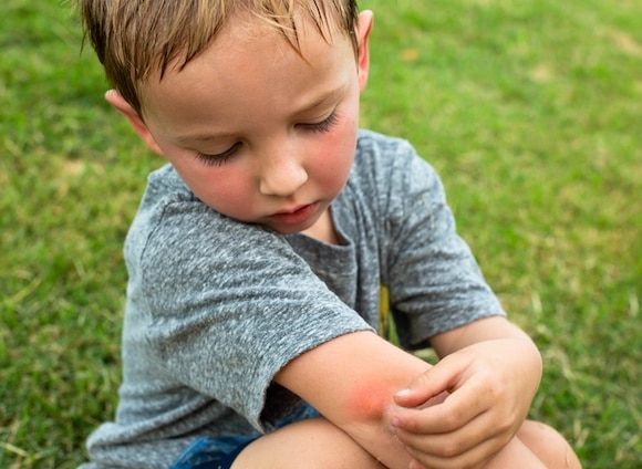 A little boy scratching his arm from a red mosquito bite