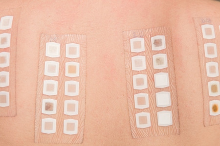Patch Test - Back Patches on Skin Testing for Allergies