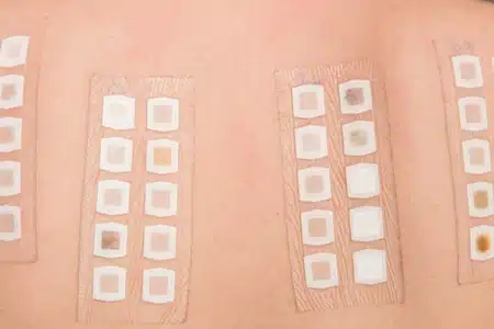 Patch Test - Back Patches on Skin Testing for Allergies