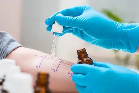 Skin Allergy Testing - Skin Scratch Test