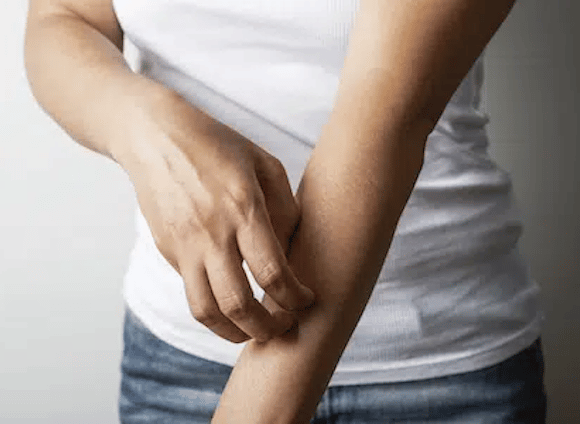 Woman scratching her hand - symptoms of milk protein allergy