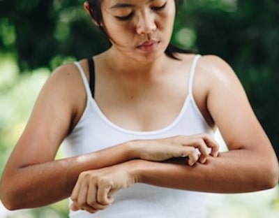 Hives (Urticaria)