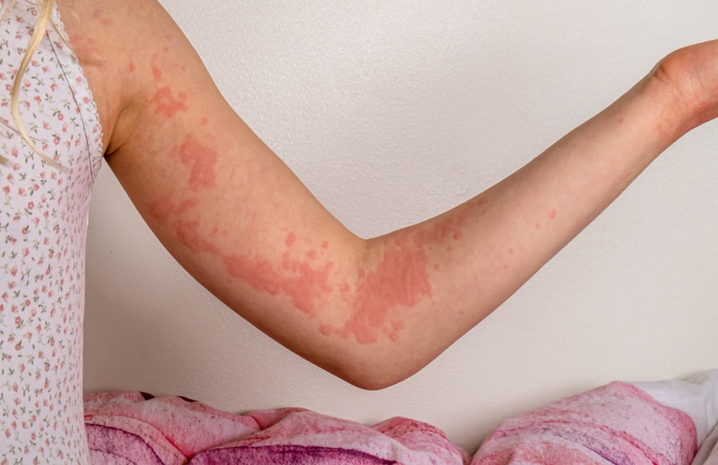A girl's arm with urticaria skin lesions (hives). Girl sitting on a bed, wearing a sleeveless top