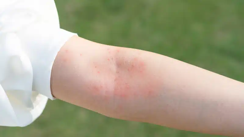 Closeup of the arm of a little girl with eczema in the summer months