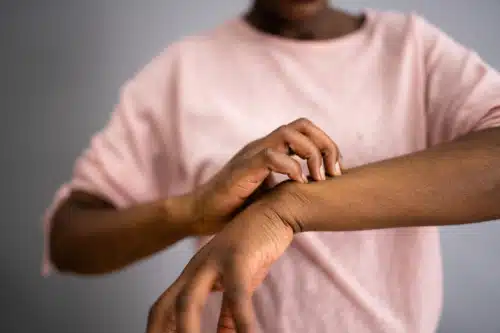 African American woman scratching her arm due to hives (urticaria)